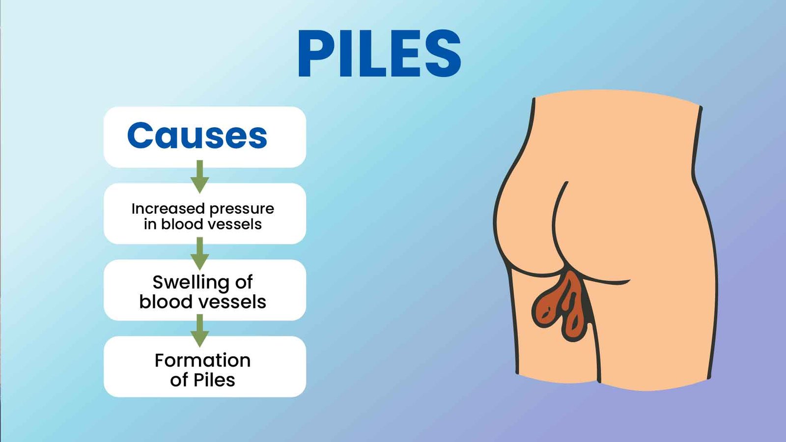 Piles Causes